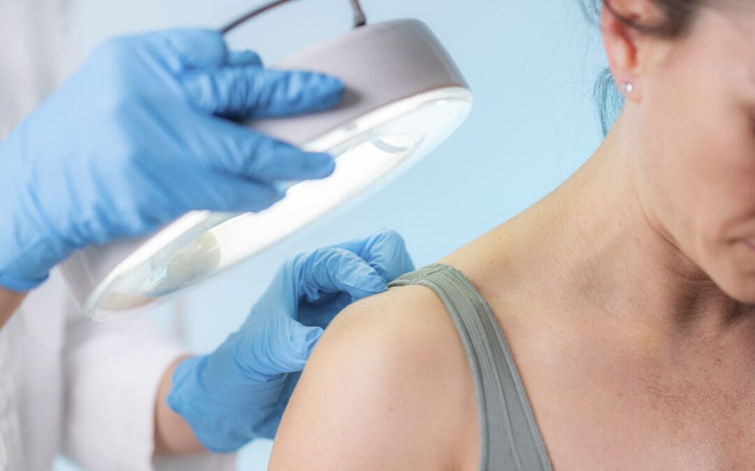How to Detect Skin Cancer